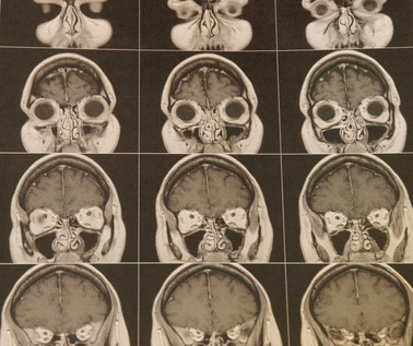the brain, the causes