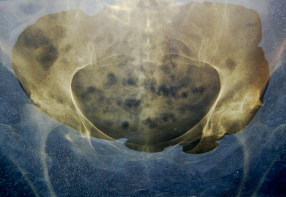 An X-ray, hip pain, walking