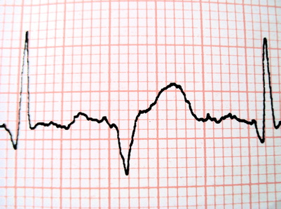 Heart palpitations, pregnancy