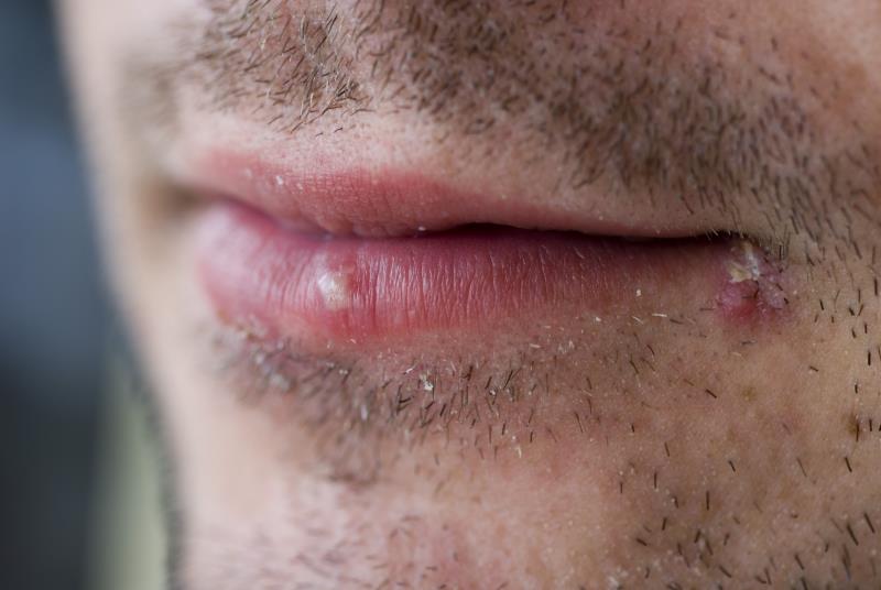 Do i have facial herpes Deep interracial anal