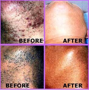 Stages Of Underarm Hair
