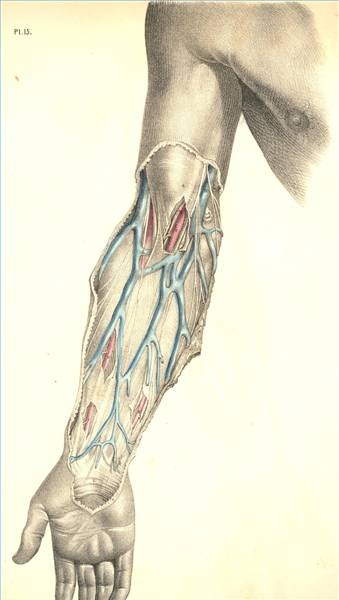 basilic vein thrombosis treatment